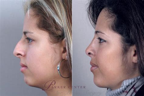 Cheekchin Implants Before And After Photo Gallery Paramus Nj