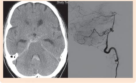 Ct Brain Showing Acute Subarachnoid And Intraventricular Hemorrhage