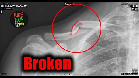I Crashed And Broke My Collarbone My Road To Recovery Youtube