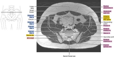 MRI Of The Male Pelvis Radiology Key
