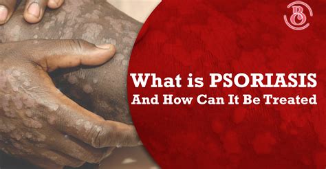 What Is Psoriasis And How Can It Be Treated Beaucrest