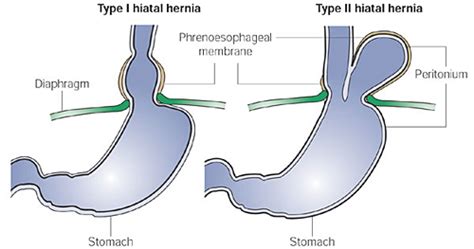 Hiatal Hernias Gastrointestinal Medbullets Step 1