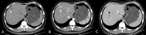 Criteria For Hepatocellular Carcinoma During Multiphase Ct A Plain