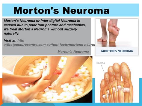 New Treatment For Mortons Neuroma Robayo Roegner 99