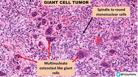 Giant Cell Tumor Of Bone Histology