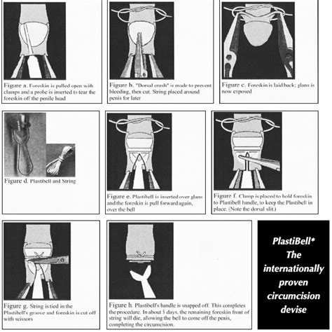 Product Plastibell® Circumcision Device 12cm