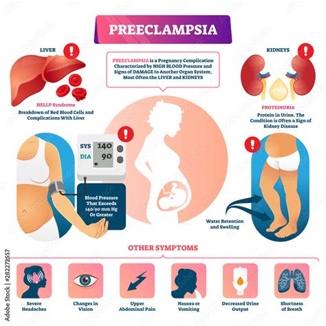 Preeclampsia Vector Illustration Labeled Pregnancy Complication Scheme