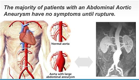 Abdominal Aortic Aneurysms Prevention