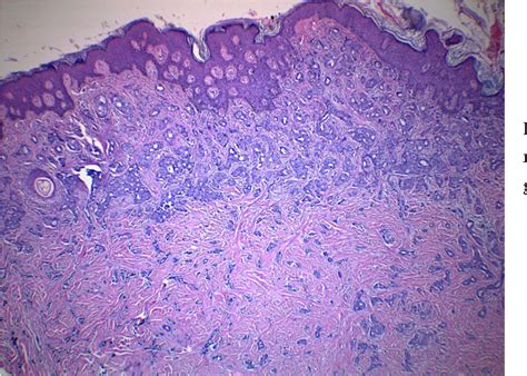Figure 2 From Primary Breast Carcinoma Arising From Ectopic Breast