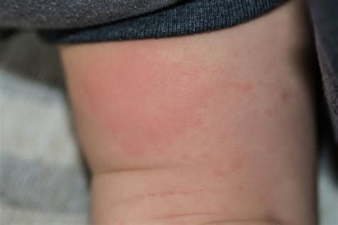 Skin Food Allergic Reaction Rash Naturalskins