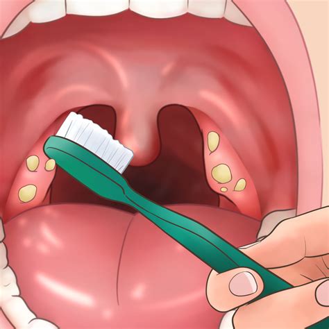 How To Completely Get Rid Of Tonsil Stones Eternally Vosdi