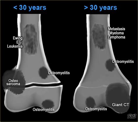 Cancers Of The Bone Metastatic Myeloma Medical School Stuff