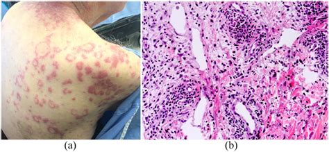 Palisaded Neutrophilic And Granulomatous Dermatitis Clinical