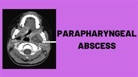 Parapharyngeal Abscess Youtube