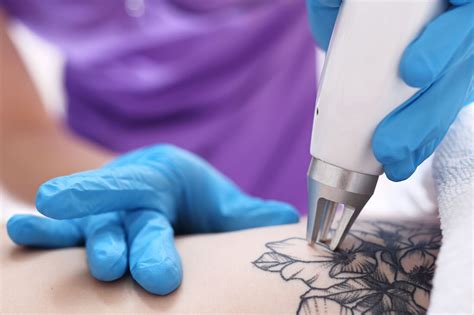 Laser Tattoo Removal Singapore Apax Medical And Aesthetics Clinic