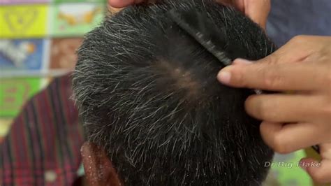 Wow Big Dandruff Removal Psoriasis With Worm On Hole Itchy On Scalp