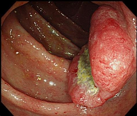 The transverse colon follows the ascending colon and hepatic flexure. Missed ascending colon cancer in an older patient with ...