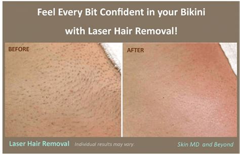 laser hair removal plano tx hair removal frisco tx dermatology
