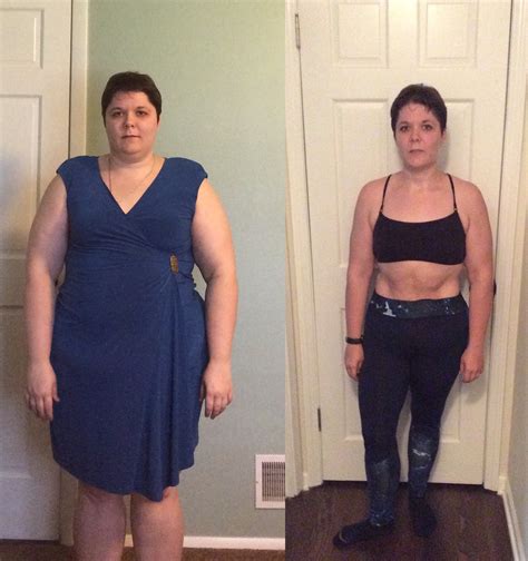 Captivating Weight Loss Surgery Before And After Sleeve Best