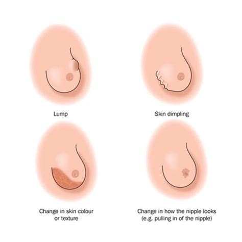 Another telltale sign of inflammatory breast cancer is skin dimpling, or pitted skin. Pix News:Symptoms Of Breast Cancer In Pix - Geyrilsworld