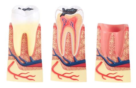 What Are Dental Caries Caused Symptoms Dental Caries Treatment