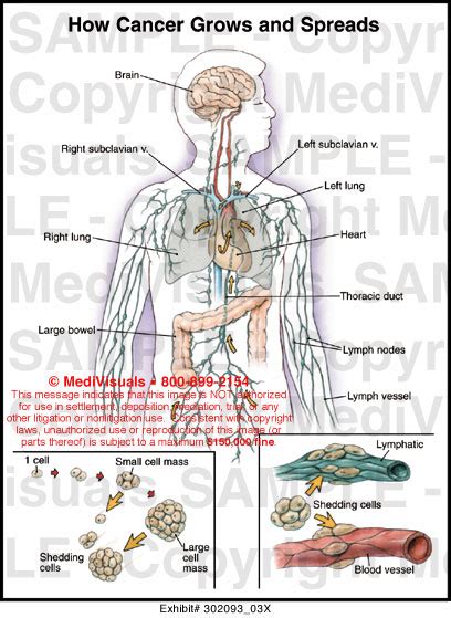 How Cancer Grows And Spreads Medical Illustration Medivisuals