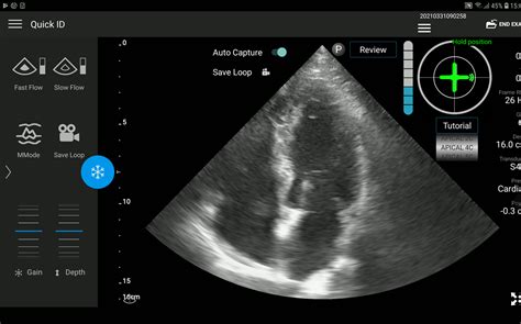Heart Ultrasound Guidance Startup Gets 13 Million From Investors The