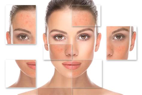 What Is Rosacea And How Can You Treat It Better Homes And Gardens