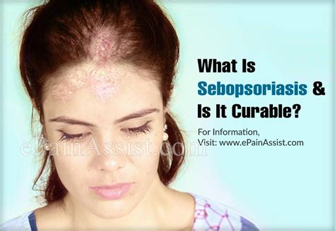 What Is Sebopsoriasis And Is It Curablesymptoms Treatment Of Sebopsoriasis