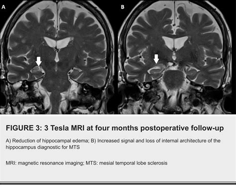 Pdf A Case Of Mesial Temporal Lobe Sclerosis Following Temporal Bone