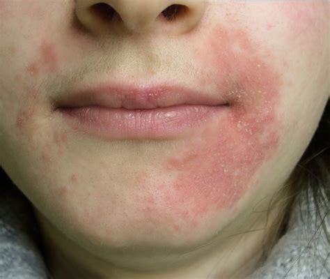 Dermatite Periorale Cosè Cause Sintomi e Cura