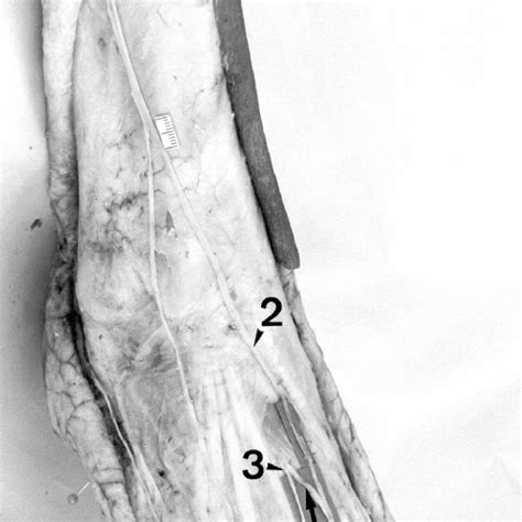 Right Lower Limb Anterior View The Superficial Fibular Nerve 1