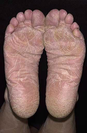 Image Scaling Of The Entire Sole In Athlete S Foot Tinea Pedis 《默沙东