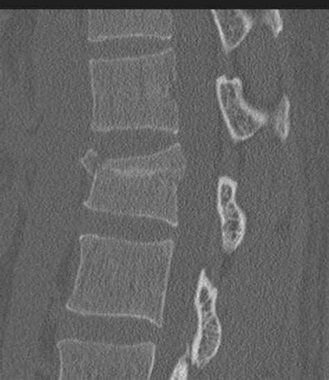 Acute L1 Burst Compression Fracture Image