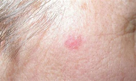 Basal Cell Carcinoma Bcc My Skin Cancer Clinic