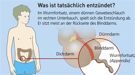 Das video ist teil der serie beliebte suchanfragen 2019 bei google von alexa beantwortet. Organe: Der Blinddarm ist gar nicht so nutzlos wie gedacht ...