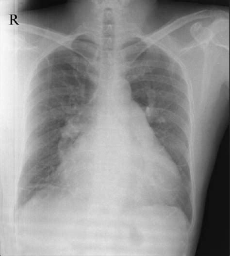 Cardiomegaly On Chest X Ray