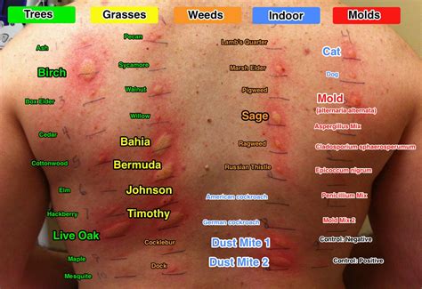 Allergy Testing For Mold Allergy Remedies Dust Allergy Dust Mite