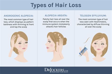 Alopecia Types Of Hair Loss What Is Alopecia Types And Causes