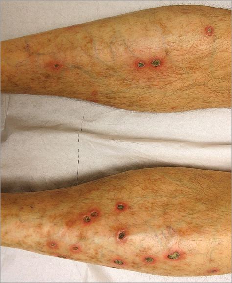 Telaprevir Induced Acquired Perforating Dermatosis Dermatology Jama
