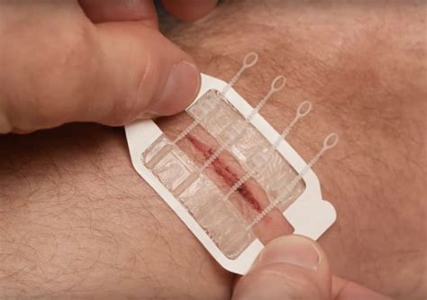 Zipstitch The Hospital Grade Wound Closure Device For Everyday Use