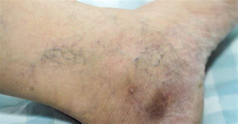 Genervt Werden Himmel Canberra Black Spots On Skin Legs Disziplin Hallo