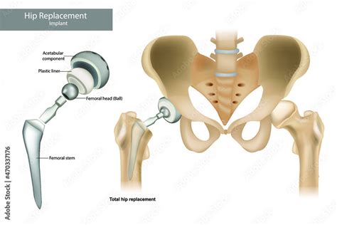 Total Hip Replacement Components And Hemiarthroplasty Hip Implant Stock Vector Adobe Stock
