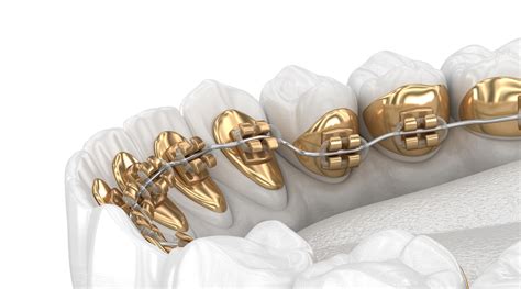 Lingual Braces Im Orthodontics