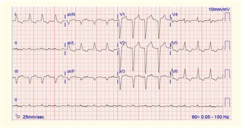 Figure 1 From Diagnosis Of Acute Myocardial Infarction In Left Bundle