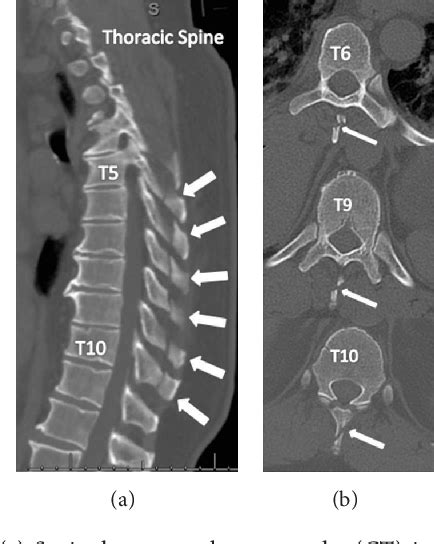 Figure 1 From Multiple Adjacent Isolated Thoracic Spinous Process