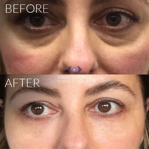 Under Eye Filler Before And After Change Comin