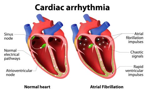 What Is A Cardiac Arrhythmia First Aid For Free