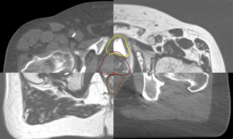 The Accuracy Of Magnetic Resonance Cone Beam Computed Tomography Soft