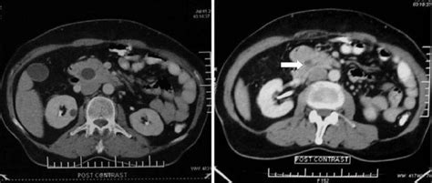 Contrast Enhanced Ct Abdomen Showing Distended Gallbladder With Dilated